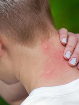 Älä raavi! Kortisonivoide lievittää kutinaa. Kokeile myös kuumaa kahvikuppia!