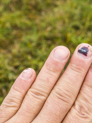 Tavallisin syy kynnen alle ilmestyneille tummille läiskille on verenvuoto: kynnen on satuttanut johonkin.