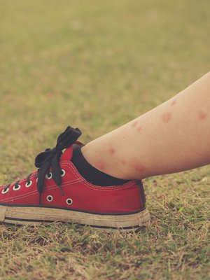 Ärtyneitä hyttysenpistoja voi hoitaa hydrokortisonilla.